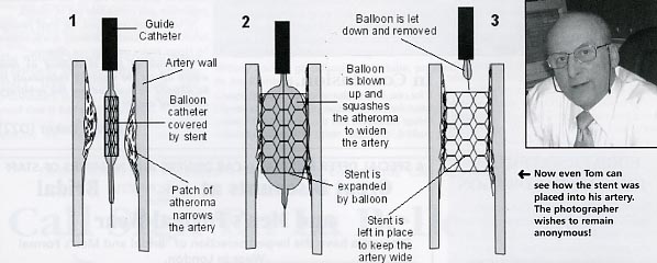 Now even Tom can see how the stent was placed into his artery.  The photographer wishes to remain anonymous!